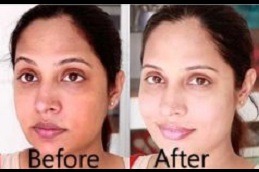 Best skin whitening Clinic in Islamabad & Rawalpindi