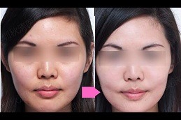 Best skin whitening in Islamabad