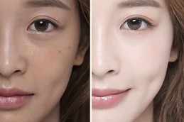 skin whitening Clinic in Islamabad & Rawalpindi