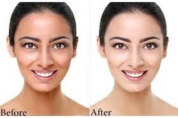 skin whitening in Islamabad