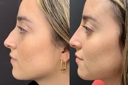 Best non surgical nose job cost Clinic in Islamabad & Rawalpindi