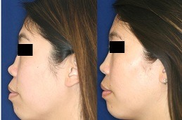 Best non surgical nose job cost Clinic in Islamabad