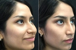 Best non surgical nose job cost in Islamabad