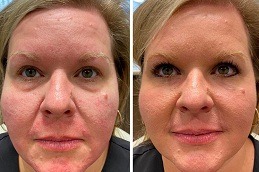 Best under eye fillers Clinic in Islamabad & Rawalpindi
