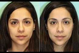 Best under eye fillers Clinic in Islamabad