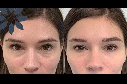 Best under eye fillers in Islamabad