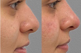 non surgical nose job cost Clinic in Islamabad & Rawalpindi