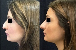 non surgical nose job cost Clinic in Rawalpindi