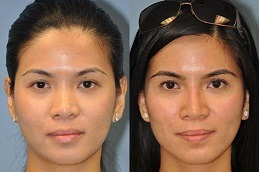 non surgical nose job cost in Islamabad