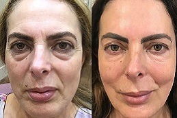 under eye fillers Clinic in Islamabad & Rawalpindi