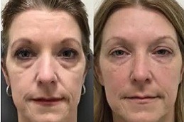 under eye fillers Clinic in Rawalpindi