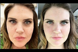 under eye fillers in Islamabad