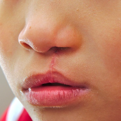 Cleft Lip and Palate Surgery in Islamabad Pakistan Cost & Price