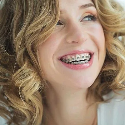 Dental Braces in Islamabad