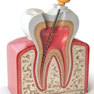 Root Canal Treatment Cost in Islamabad