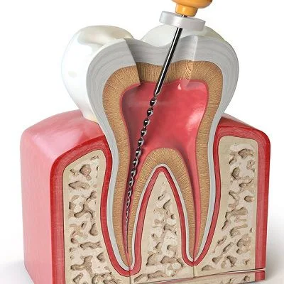 Root Canal Treatment Cost in Islamabad