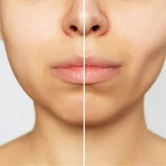Buccal Fat Removal Cost in Islamabad