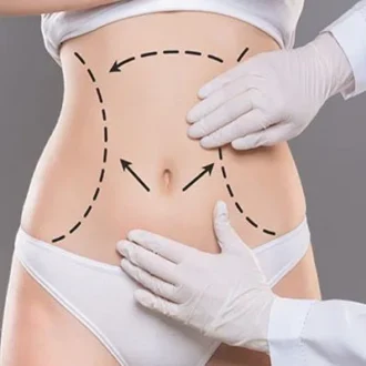 Liposuction Cost in Islamabad