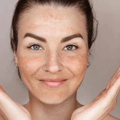 Melasma Treatment cost in Islamabad