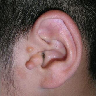 Preauricular Tag Removal Cost in Islamabad