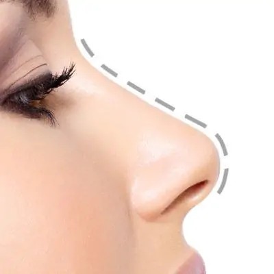 Rhinoplasty in islamabad