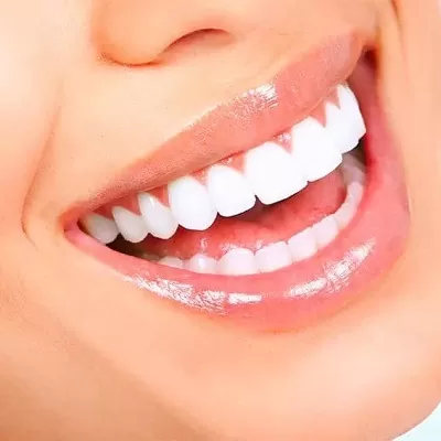 Laser Teeth Whitening in Islamabad