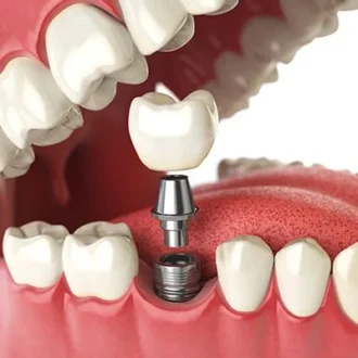 Dental Implants Cost in Islamabad