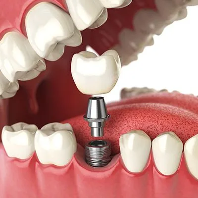 Dental Implants Cost in Islamabad