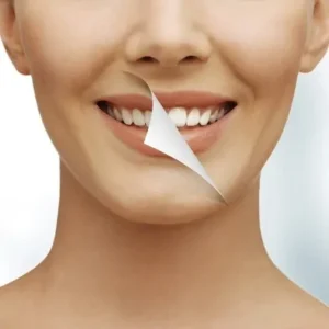 Can Laser Teeth Whitening remove stains permanently?
