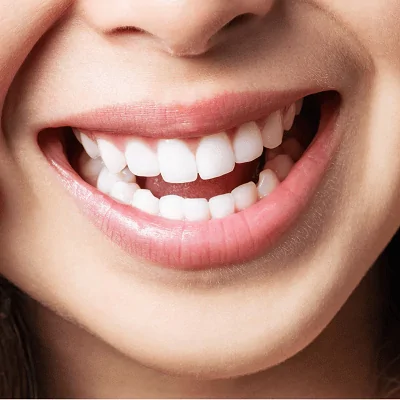 What are the pros and cons of Laser Teeth Whitening?