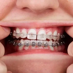 Do Dental Braces Really Work for Crooked Teeth?