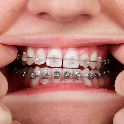 Do Dental Braces Really Work for Crooked Teeth?