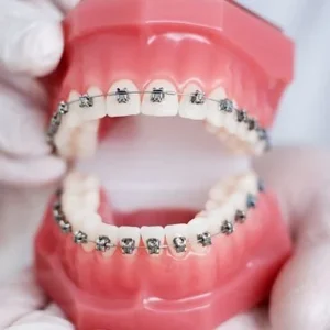Can Adults Get Dental Braces? Pros and Cons