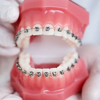 Can Adults Get Dental Braces? Pros and Cons