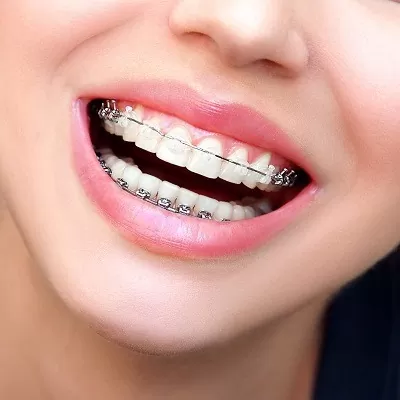 Do Dental Braces Permanently Straighten Teeth?