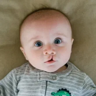 Cleft Lip And Palate Surgery Cost in Islamabad