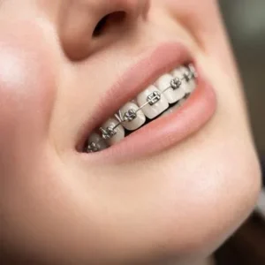 How Much Do Dental Braces Cost in Islamabad?