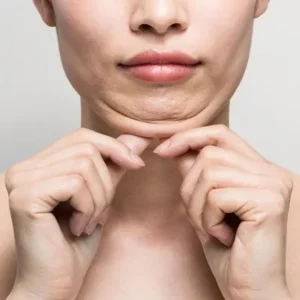 Chin Reduction Cost in Islamabad