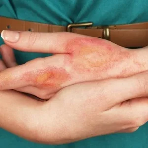 Burn Reconstructive Surgery Cost in Islamabad