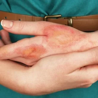 Burn Reconstructive Surgery Cost in Islamabad