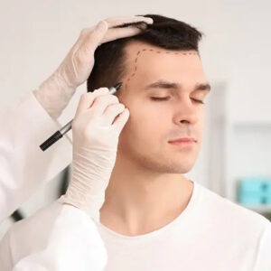 How Much Does a Hair Transplant Cost in Islamabad