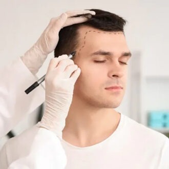 How Much Does a Hair Transplant Cost in Islamabad
