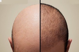 Hair Transplant clinic before & After in islamabad