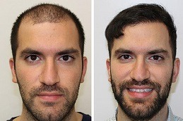 Hair Transplant clinic before & After.