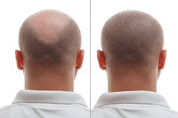 Hair Transplant clinic in Islamabad.