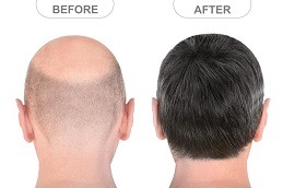 Hair Transplant clinic in Islamabad