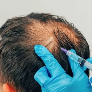 Best PRP Treatment in Rawalpindi