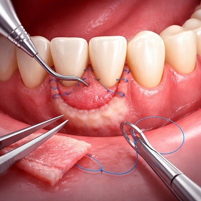 Gum Grafting in Islamabad