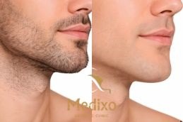 beard laser hair removal in Islamabad