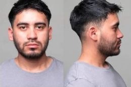 Before and After Result of Jawline Fillers in Islamabad